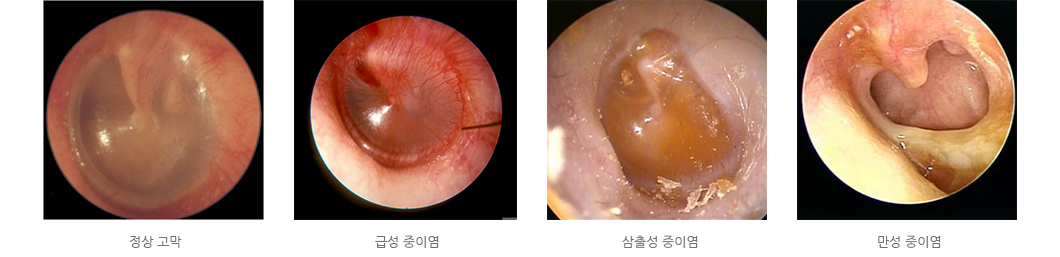 중이염