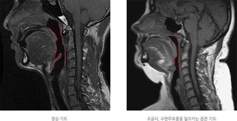 코골이,수면무호흡